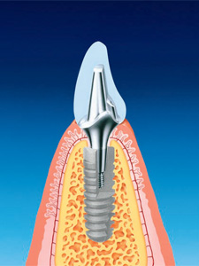 噛み合わせを補うのに最適なインプラント