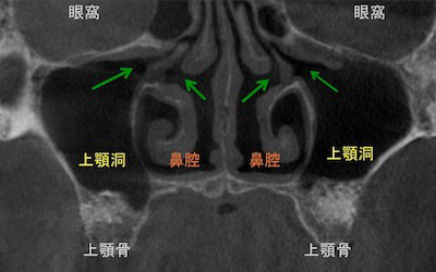 上顎の場合