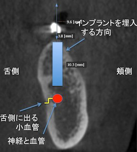 下顎の場合